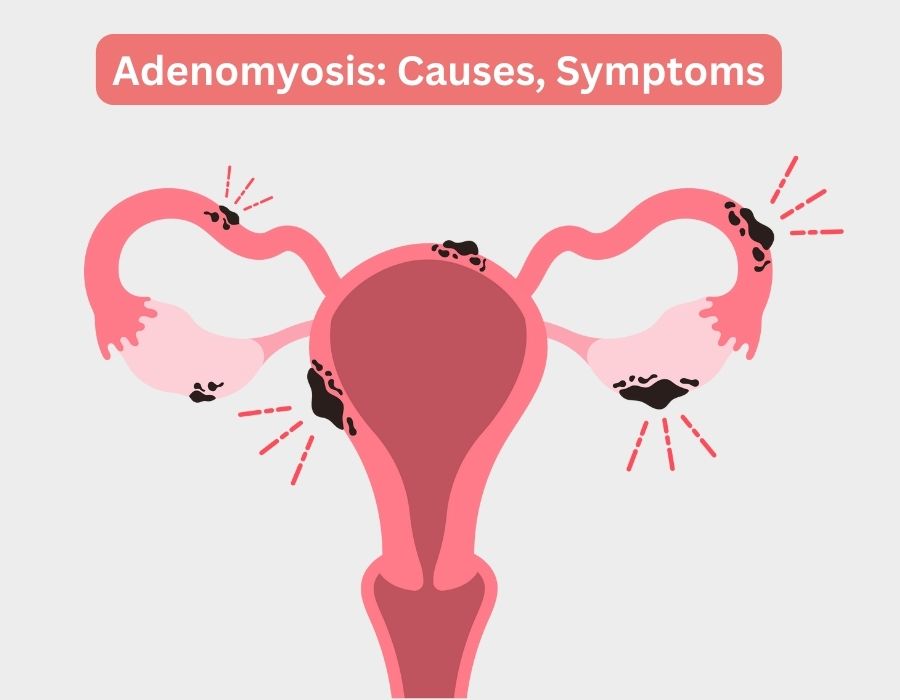 Adenomyosis: Causes, Symptoms | Dr. Sonal Katarmal